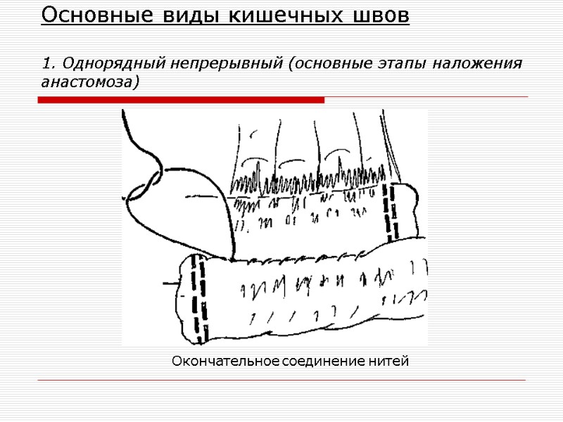 Основные виды кишечных швов  1. Однорядный непрерывный (основные этапы наложения анастомоза) Окончательное соединение